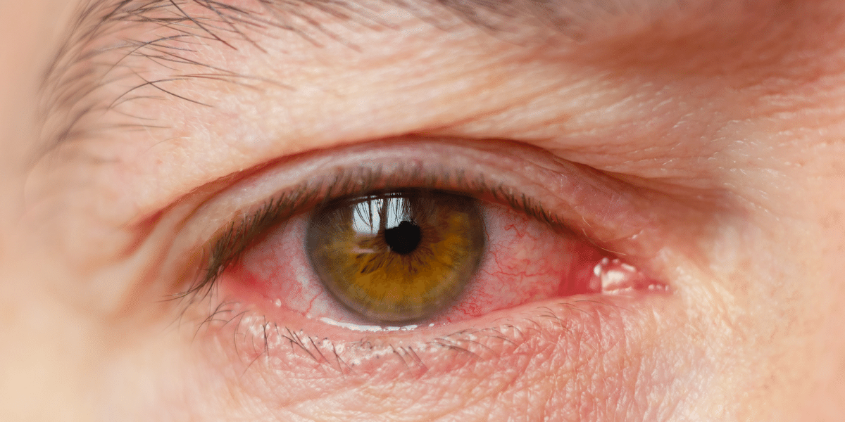 Bolinha no olho: o que pode ser? – Central da Visão