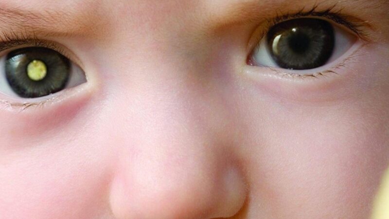 Criança cm uma manchinha em um dos olhos (câncer de olho)