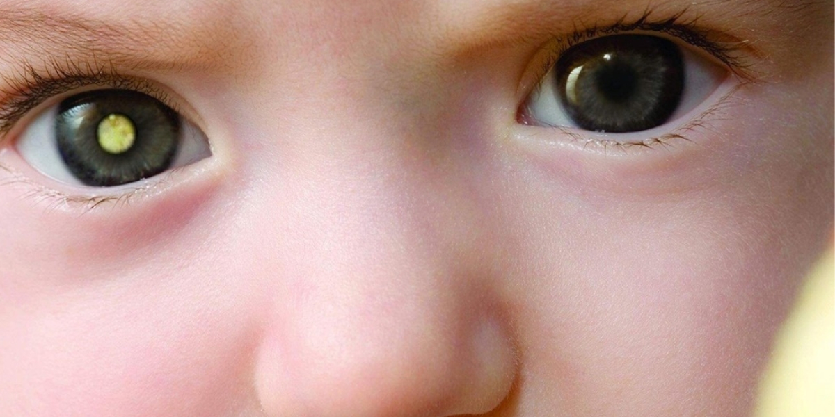 Criança cm uma manchinha em um dos olhos (câncer de olho)