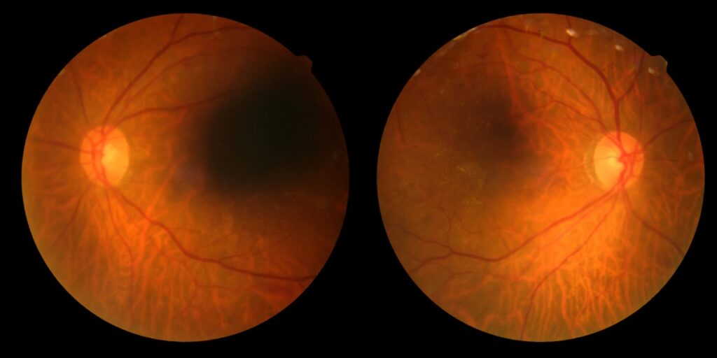 O que é a retinopatia diabética e como ela pode ser tratada? 