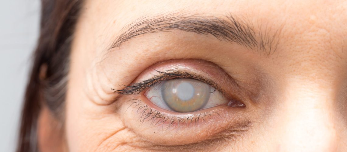 glaucoma